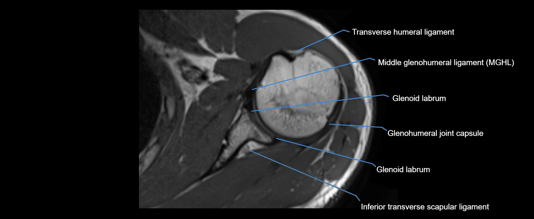 shoulder ligaments axial 3d 3t mri image-img-00005-00063.webp